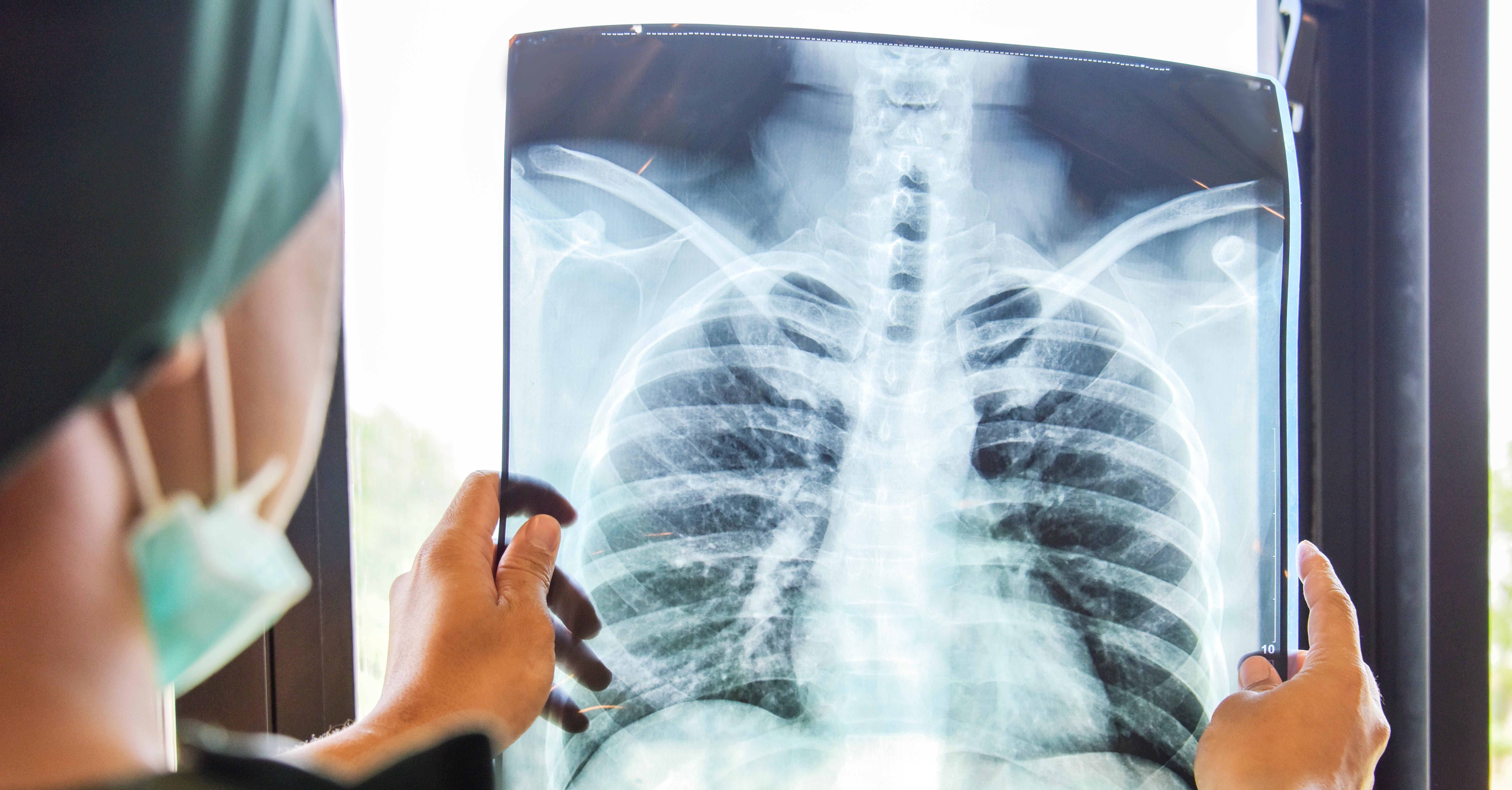 A medical professional holds onto a chest x-ray and examines the image.